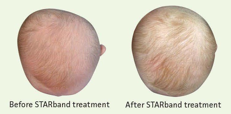 Cranial Remolding Before & After